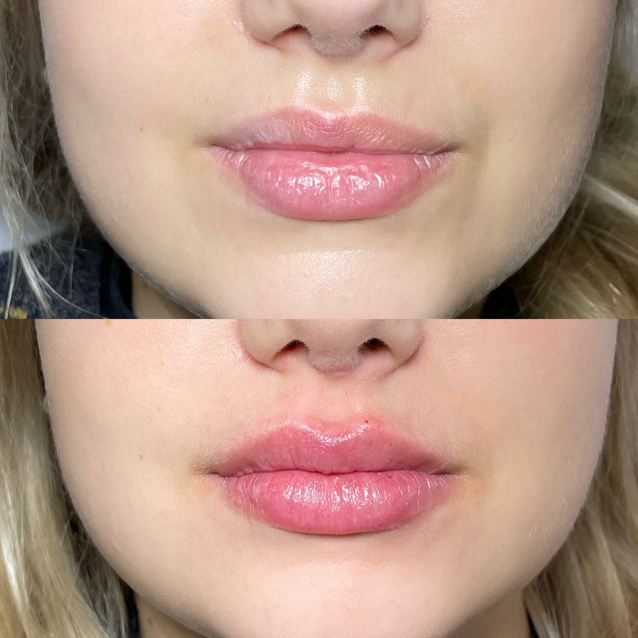 Lip Filler Treatment in London