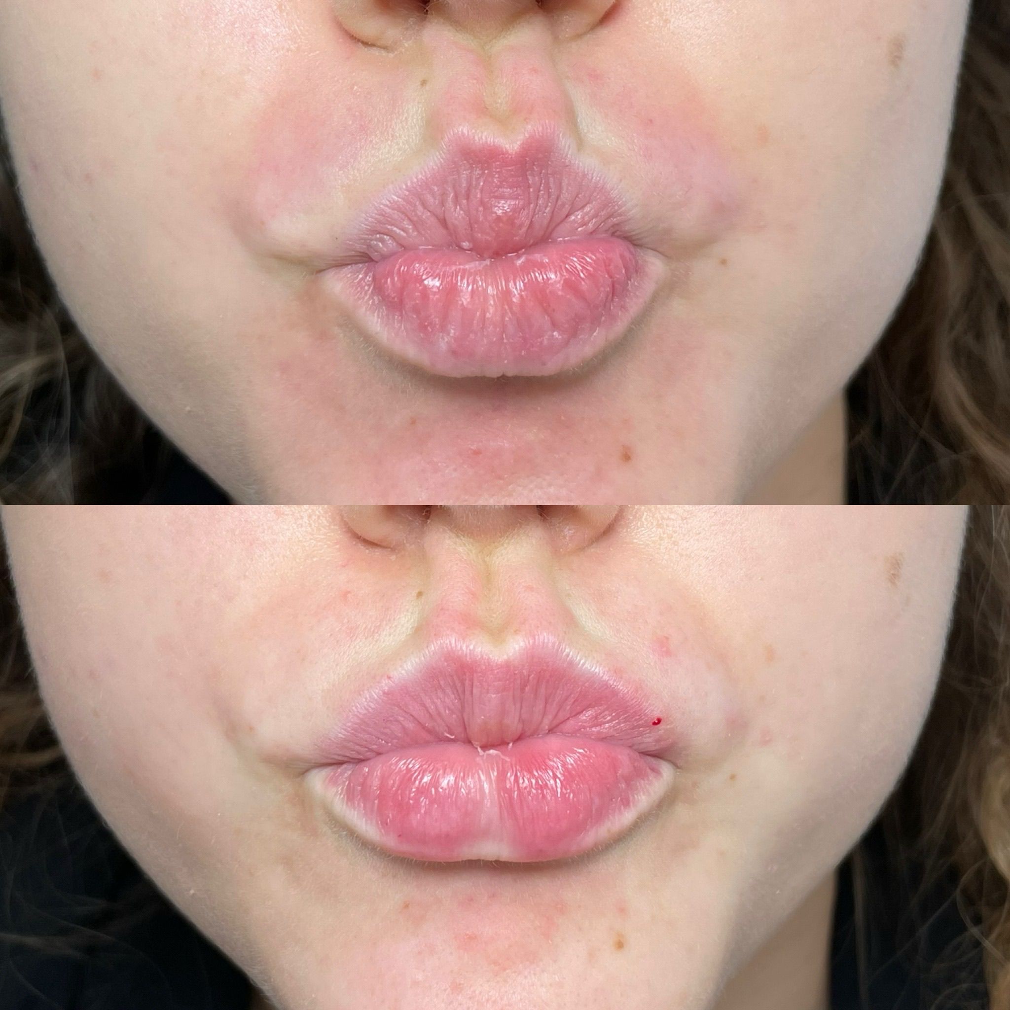 Lip Filler Treatment in London